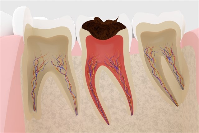 根管治療とインプラント、どっちがいい？現役歯科医が徹底比較！